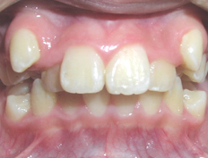 Non-extraction treatment for a patient with crowding and excessive overjet and overbite
