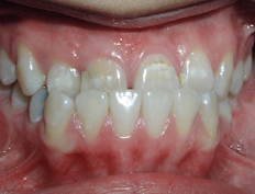 Non-extraction treatment for a patient with an anterior crossbite