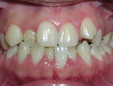 Extraction treatment for a patient with excessive crowding