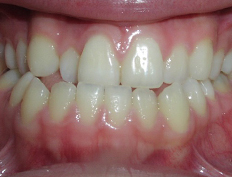 Non-extraction treatment in combination with orthognathic surgery of the lower jaw for a patient with excessive lower jaw growth.