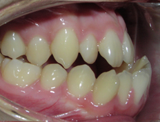 Extraction treatment in combination with orthognathic surgery of the lower jaw for a patient with excessive lower jaw growth